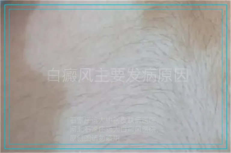 白癜风主要发病原因