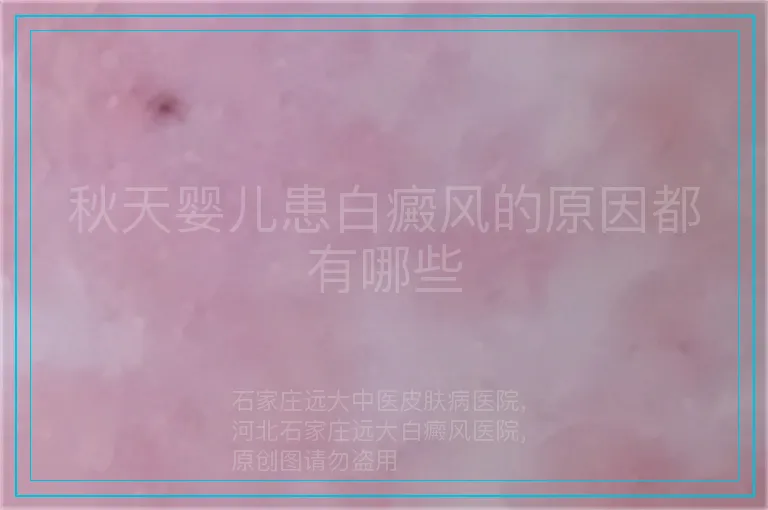 秋天婴儿患白癜风的原因都有哪些