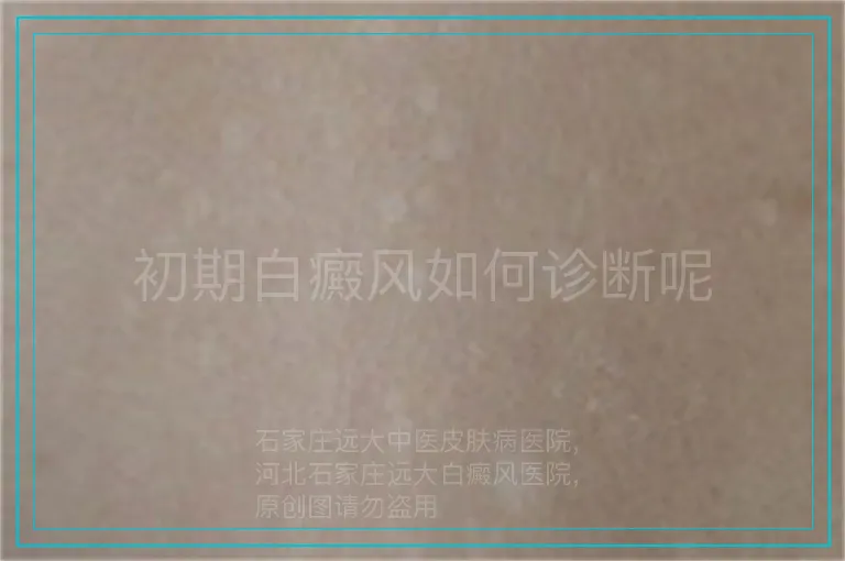 初期白癜风如何诊断呢