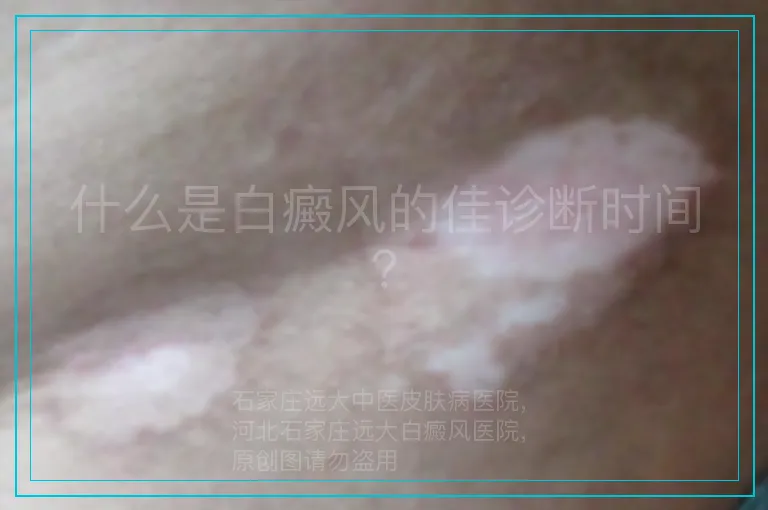 什么是白癜风的佳诊断时间？