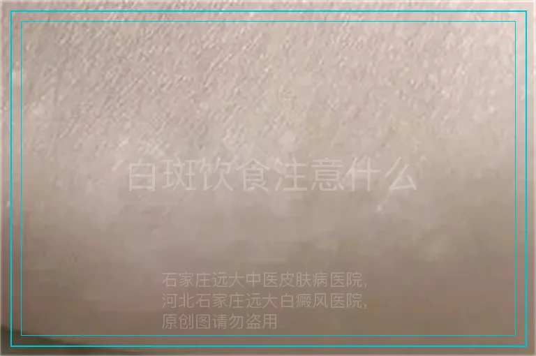 白斑饮食注意什么