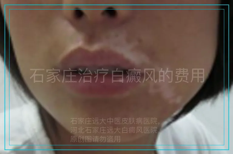 石家庄治疗白癜风的费用