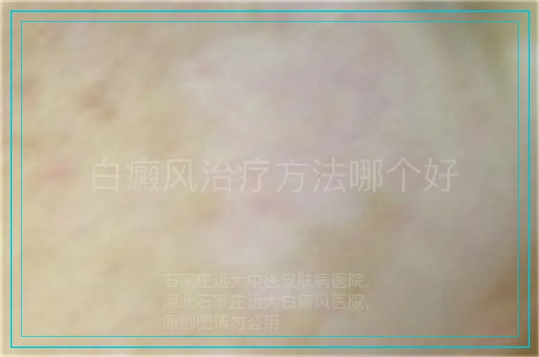 白癜风治疗方法哪个好