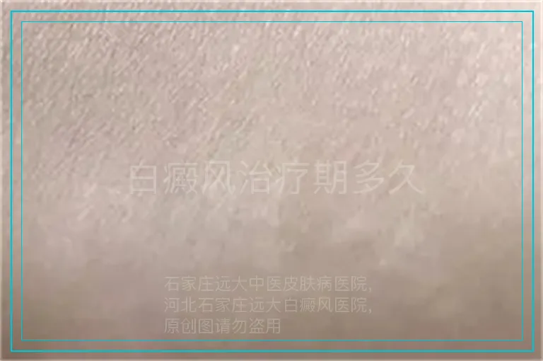 白癜风治疗期多久