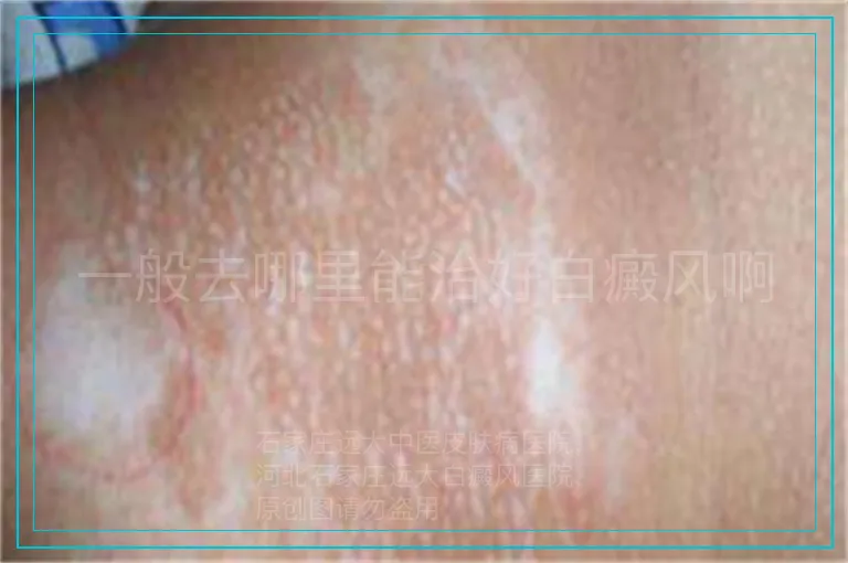 一般去哪里能治好白癜风啊