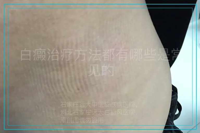 白癜治疗方法都有哪些是常见的