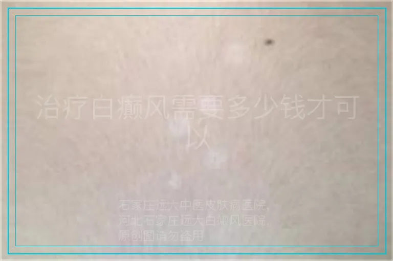 治疗白癫风需要多少钱才可以