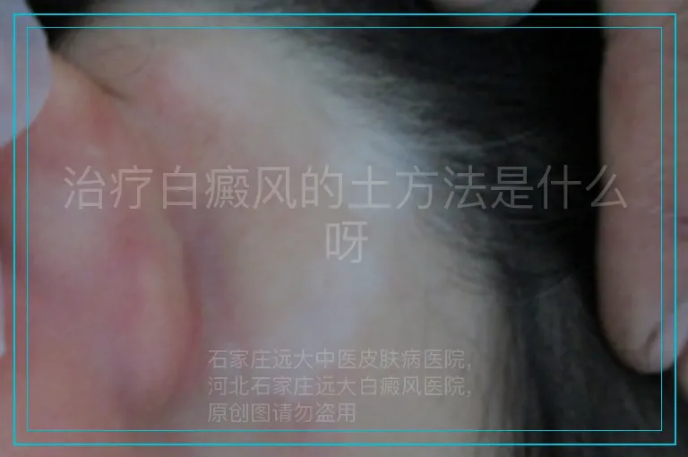 治疗白癜风的土方法是什么呀