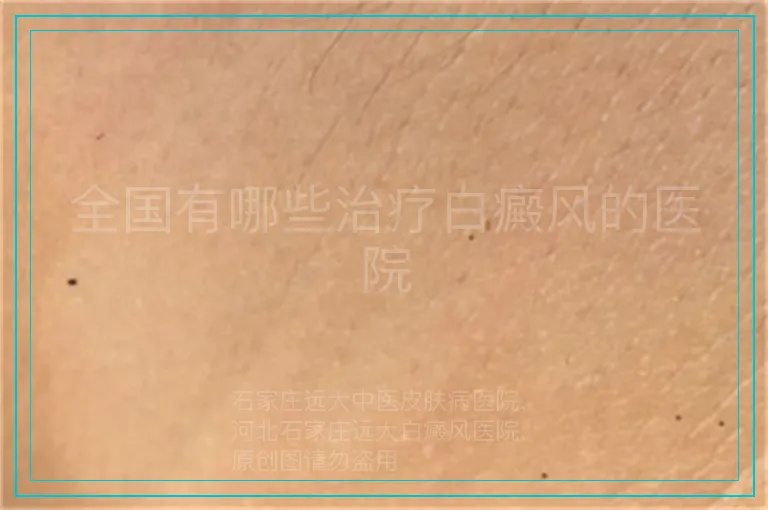 全国有哪些治疗白癜风的医院