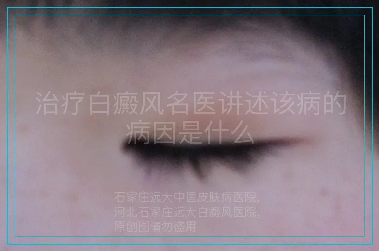 治疗白癜风名医讲述该病的病因是什么