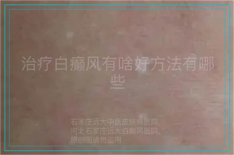 治疗白癫风有啥好方法有哪些