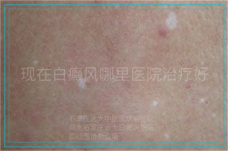 现在白癜风哪里医院治疗好
