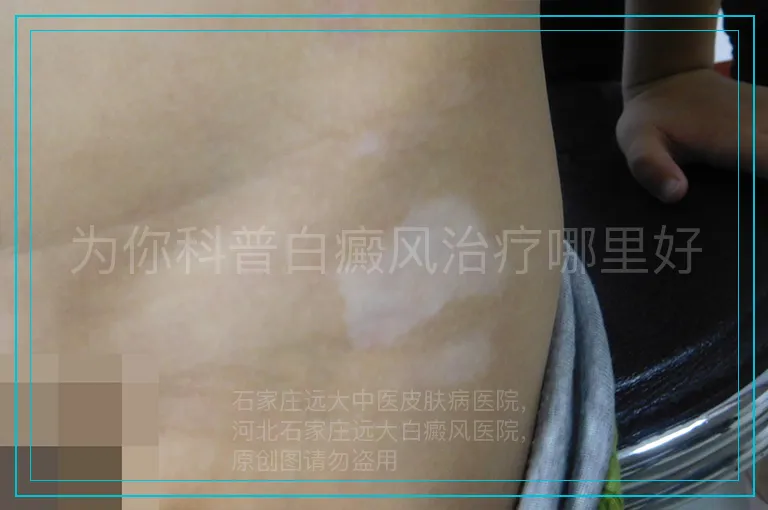 为你科普白癜风治疗哪里好