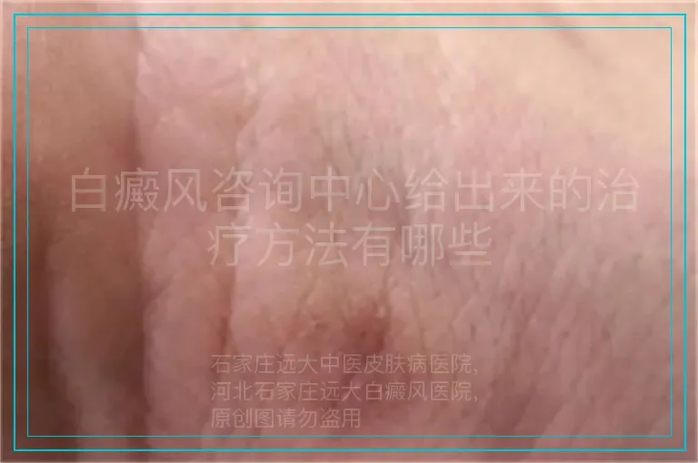 白癜风咨询中心给出来的治疗方法有哪些