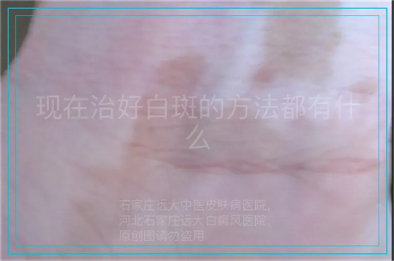 现在治好白斑的方法都有什么