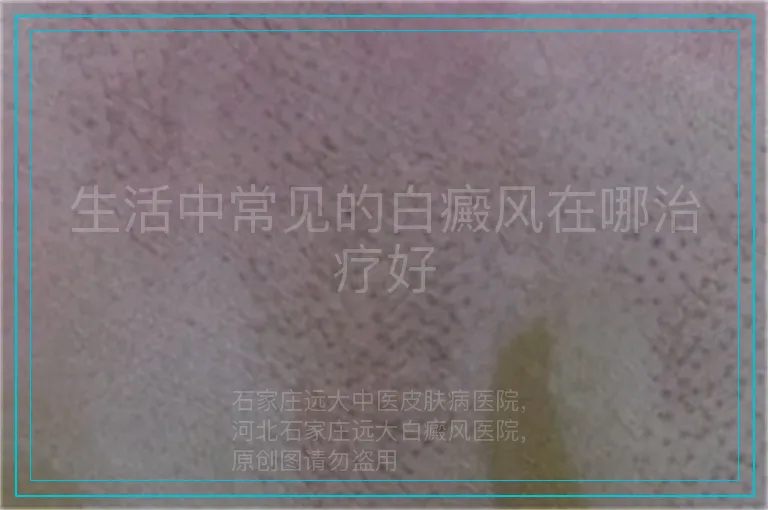 生活中常见的白癜风在哪治疗好