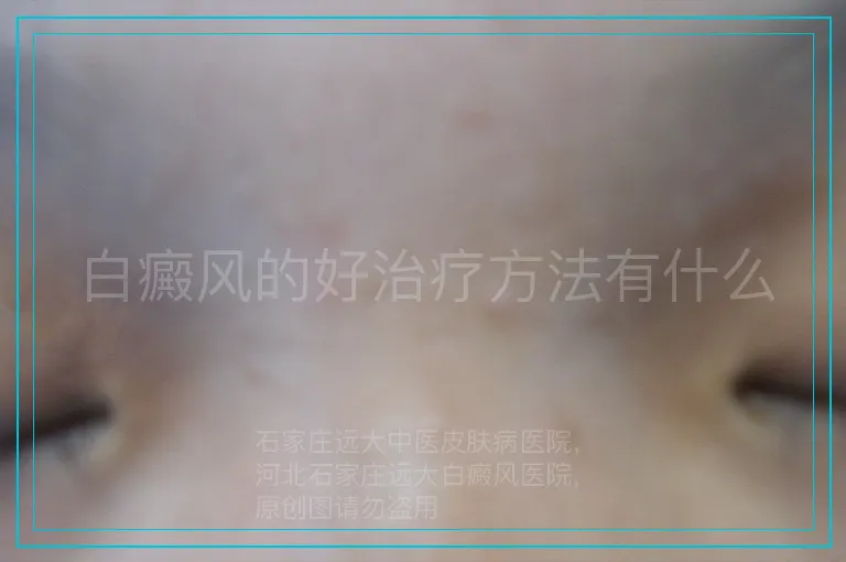 白癜风的好治疗方法有什么