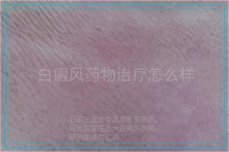白癜风药物治疗怎么样