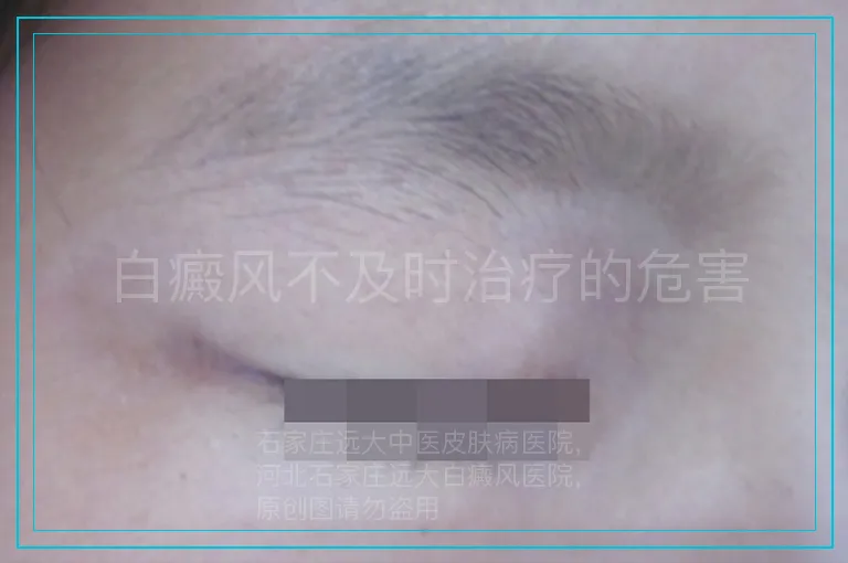 白癜风不及时治疗的危害
