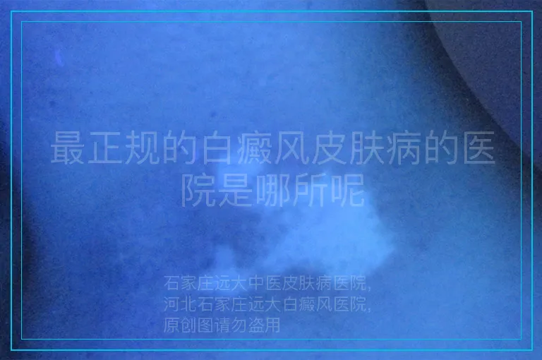 最正规的白癜风皮肤病的医院是哪所呢