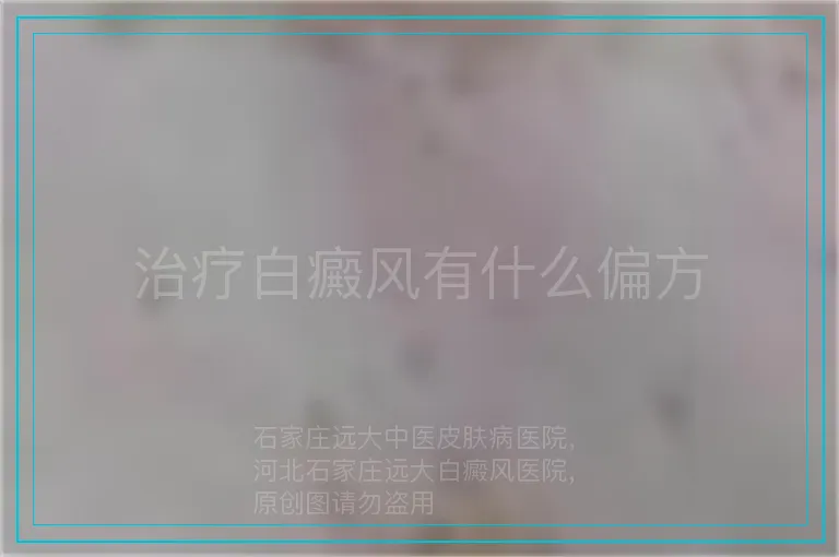 治疗白癜风有什么偏方