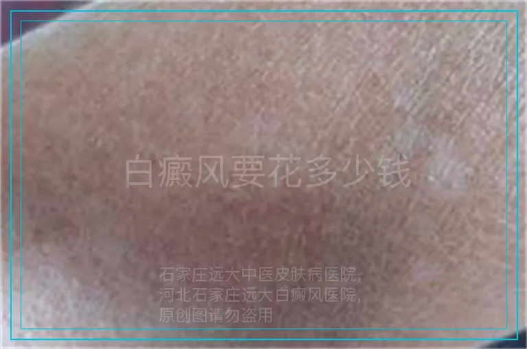 白癜风要花多少钱
