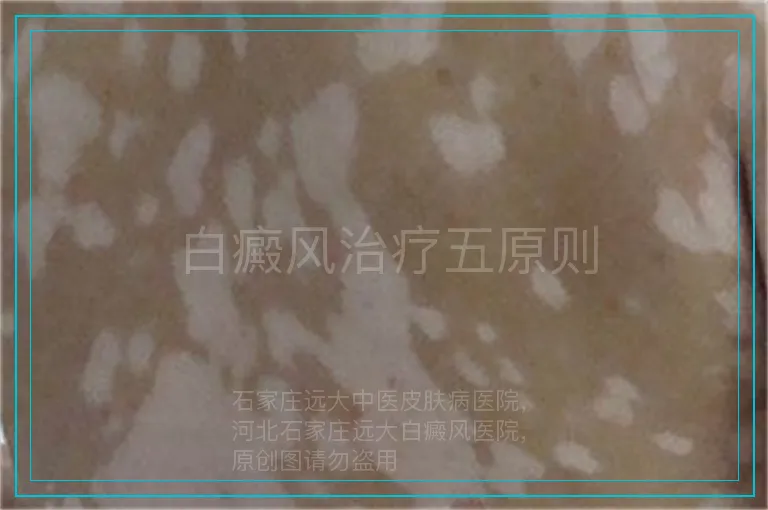 白癜风治疗五原则