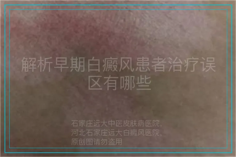解析早期白癜风患者治疗误区有哪些