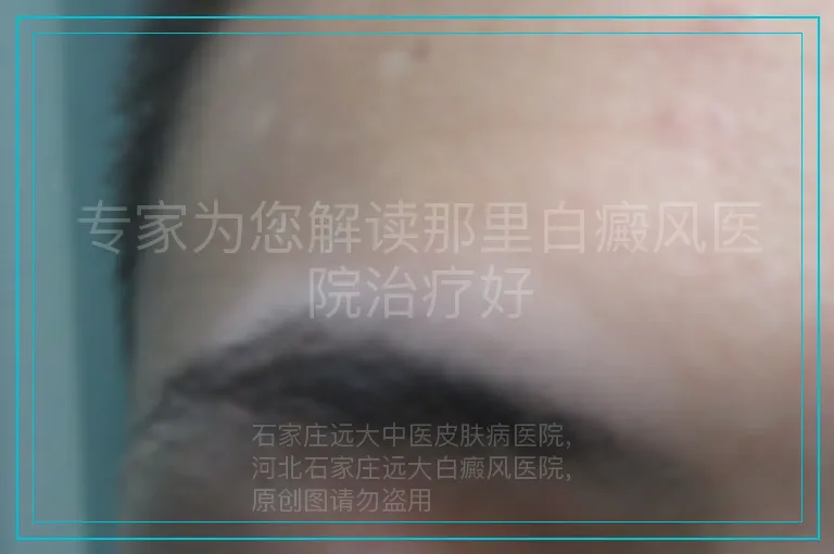 专家为您解读那里白癜风医院治疗好