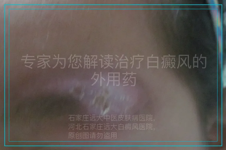 专家为您解读治疗白癜风的外用药