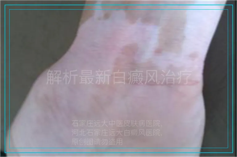 解析最新白癜风治疗