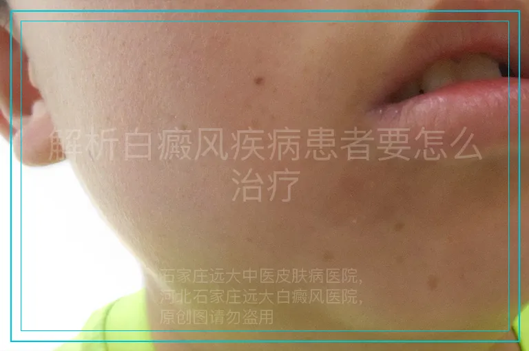 解析白癜风疾病患者要怎么治疗
