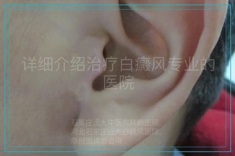 详细介绍治疗白癜风专业的医院