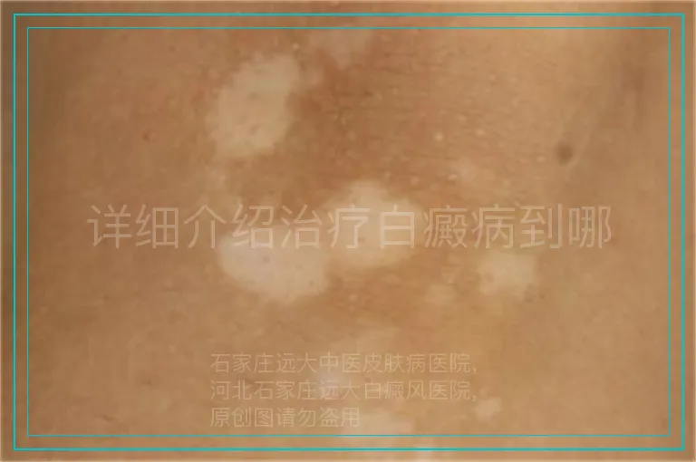 详细介绍治疗白癜病到哪