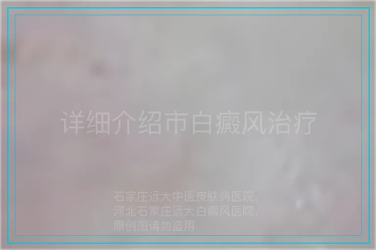 详细介绍市白癜风治疗