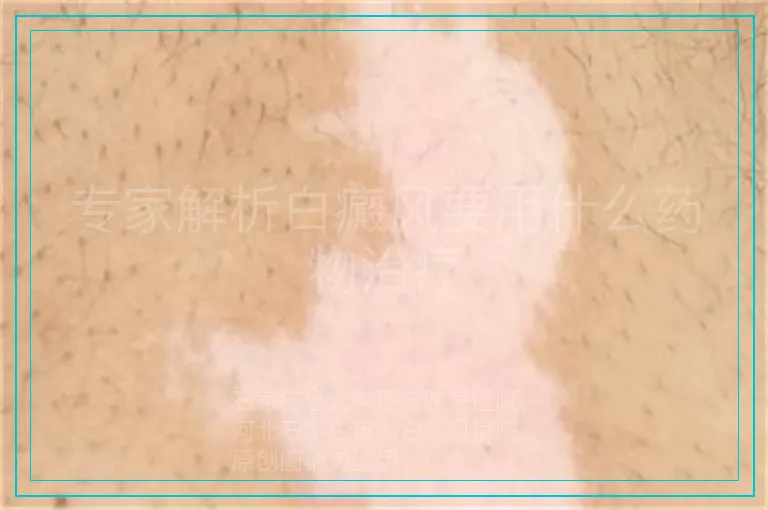 专家解析白癜风要用什么药物治疗