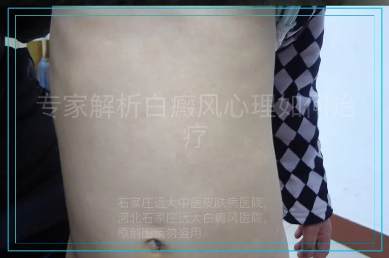 专家解析白癜风心理如何治疗