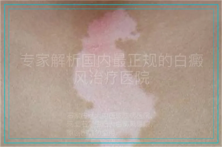 专家解析国内最正规的白癜风治疗医院