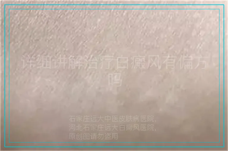 详细讲解治疗白癜风有偏方吗
