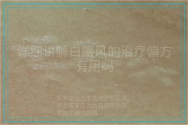 详细讲解白癜风的治疗偏方有用吗