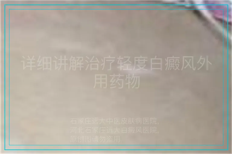 详细讲解治疗轻度白癜风外用药物