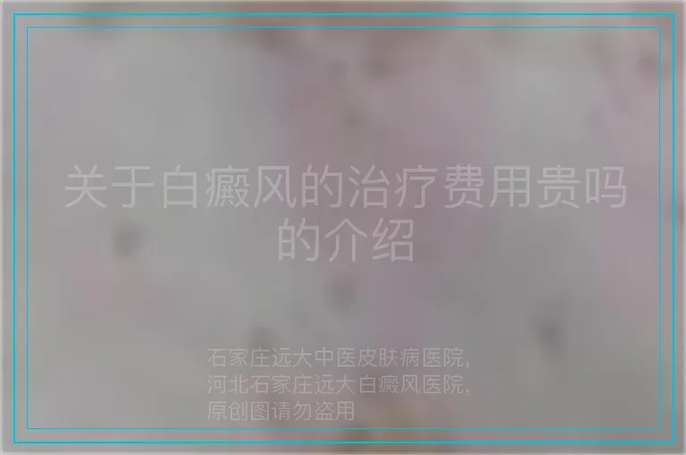 关于白癜风的治疗费用贵吗的介绍