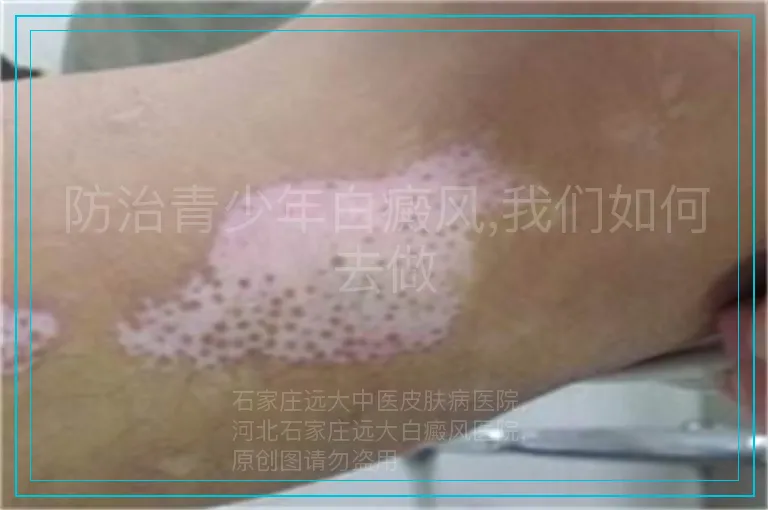 防治青少年白癜风,我们如何去做
