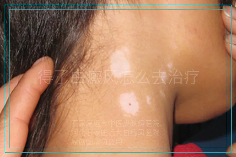 得了白癜风怎么去治疗
