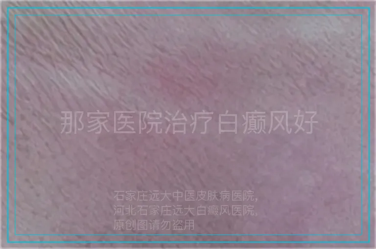 那家医院治疗白癫风好