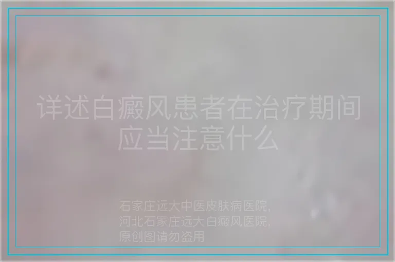 详述白癜风患者在治疗期间应当注意什么