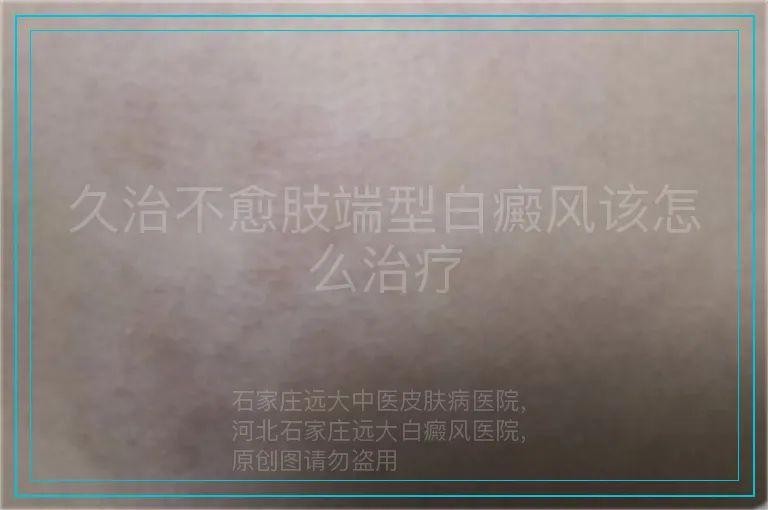 久治不愈肢端型白癜风该怎么治疗