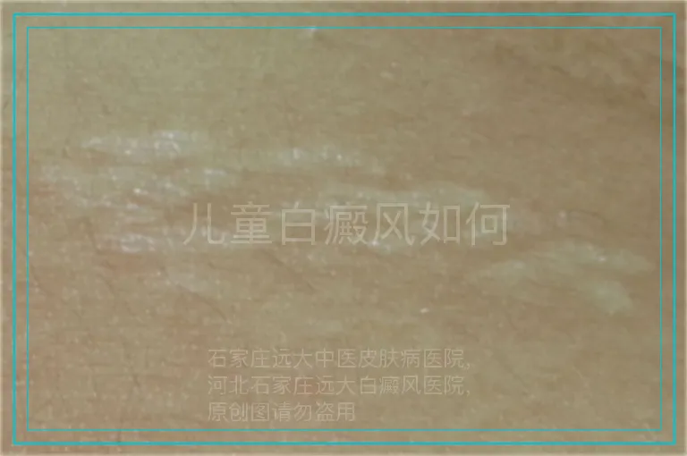 儿童白癜风如何