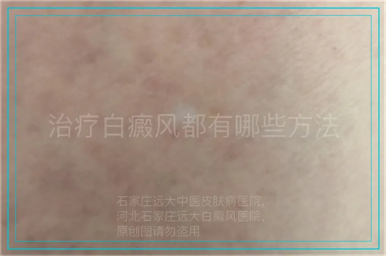 治疗白癜风都有哪些方法