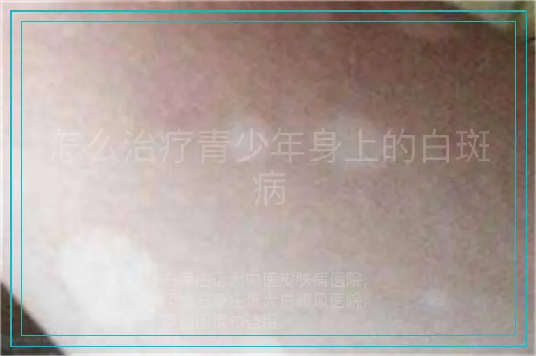 怎么治疗青少年身上的白斑病